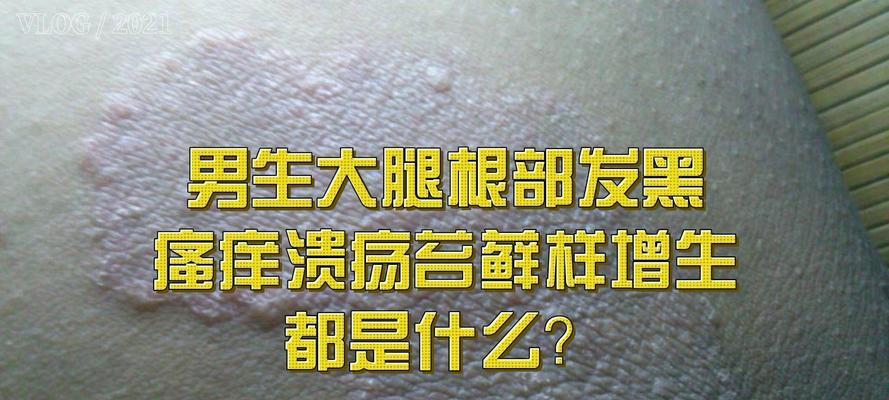 苔藓发黑的原因及处理方法（了解苔藓为什么会变黑以及如何解决）-第1张图片-绿意生活